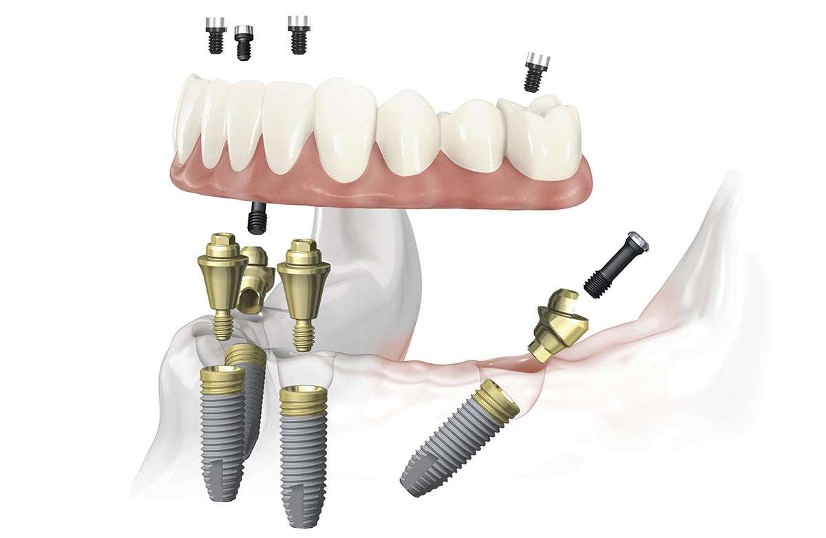 Имплантация зубов: причины замены и технологии