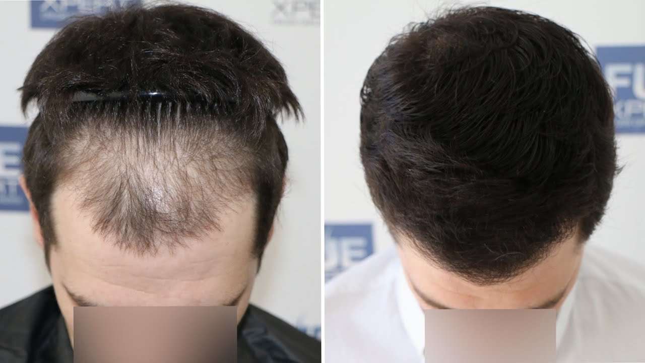 Трансплантация волос современными методами - как она происходит