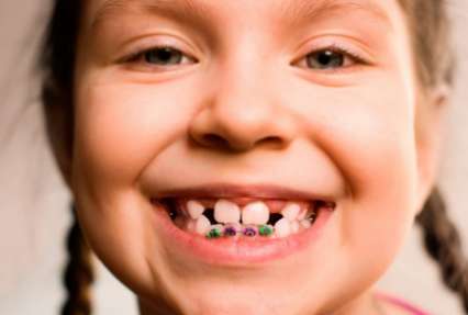 Убедитесь на примере звезд, что брекет-система сделает ваши зубы идеальными